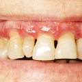Symptoms of Gum Disease: Recognizing and Treating This Common Dental Issue