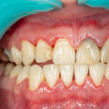 Stages of Gum Disease: Understanding the Progression of Oral Health Issues