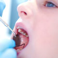 Treating Tooth Decay: A Complete Guide to Dental Care and Oral Health