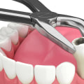 Reasons for Tooth Extraction: Understanding the Common Dental Procedure