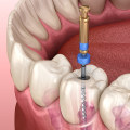 Understanding Root Canals: What You Need to Know