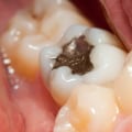 Types of Fillings: Understanding Your Dental Restorative Options