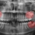 Exploring the Different Types of Oral Surgeries
