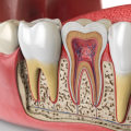 Recovery After Root Canal Treatment: What You Need to Know