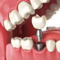 An In-Depth Look at Dental Implants