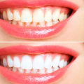 Maintaining White Teeth: Tips for a Bright and Healthy Smile