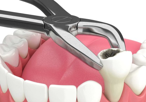 Aftercare for Tooth Extraction: What You Need to Know