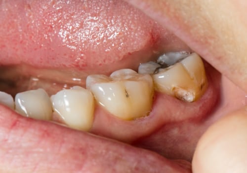 Understanding the Causes of Tooth Decay