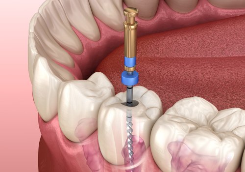 Understanding Root Canals: What You Need to Know