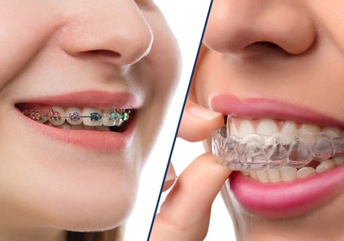 Understanding the Differences Between Invisalign and Braces