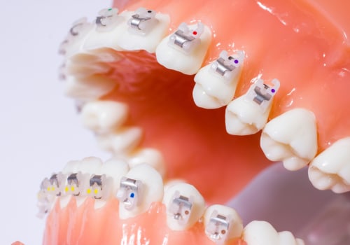 Types of Orthodontic Treatments: A Comprehensive Overview