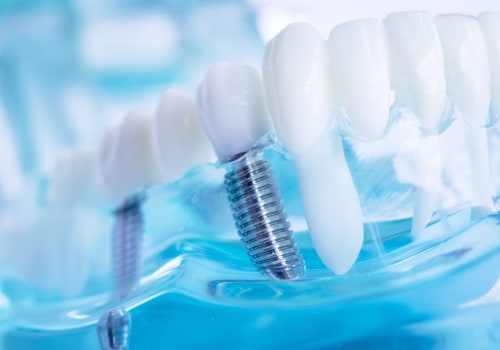 How to Properly Care for Dental Implants