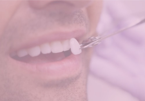 The Process for Getting Veneers or Bonding: Everything You Need to Know