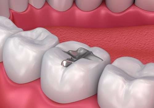 The Process of Getting a Filling: A Comprehensive Guide to Dental Care