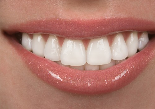 Caring for Veneers and Bonded Teeth: Tips for Healthy and Beautiful Smiles