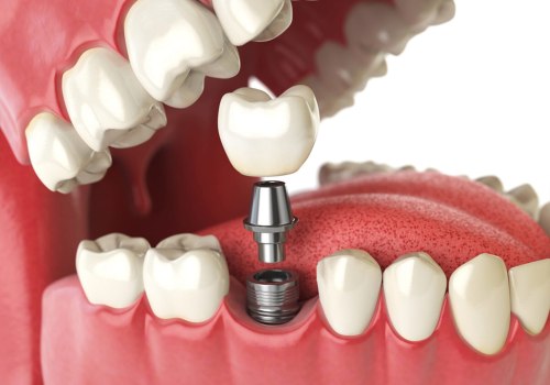 An In-Depth Look at Dental Implants